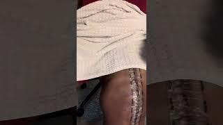 Zip line suture removal after knee replacement