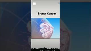 Female Breast Cancer  #viralvideo #2025