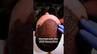 It’s not just a regular head wash  | Hair Transplant Clinic