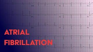 Atrial Fibrillation (Afib) - EKG (ECG) Interpretation