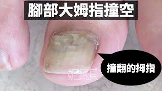 Correction of foot nails - Treatment of hollow nails on thumbs