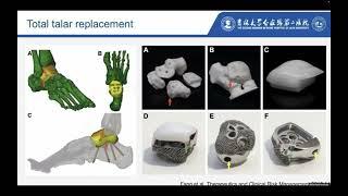 Beyond Tradition: Delving into Cutting-Edge Implants and Outcomes in Total Talus Replacement