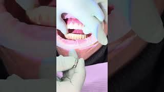 How to insert Upper Implant Hybrid with Rosen screws  by Lsk121 luke Kahng.