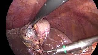 Two incision Laparoscopic Cholecystectomy