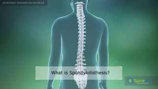 Spondylolisthesis Аnatomy