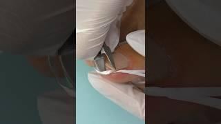 INGROWN TOENAIL  hack DIY - Worked for Me !