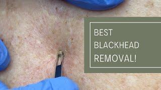 Best Blackhead Removal! | Dr. Derm