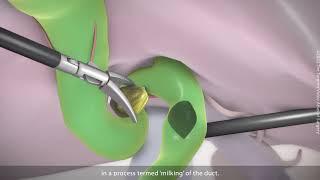 Laparoscopic Common Bile Duct Exploration | TVASurg