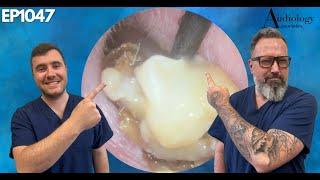 WET MASTOIDECTOMY EAR WAX REMOVAL - EP1047