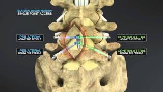 Medical Animation of Lumbar Stenosis Decompression