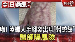 嚇! 陸婦人手腳突出現「蟒蛇紋」 醫師曝風險｜TVBS新聞 @TVBSNEWS01