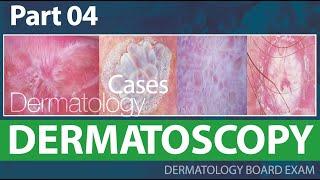 Dermatoscopy  - Dermatology cases