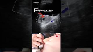 Vaginal Bleeding at 7weeks? Ultrasound Reveals Surprising Truth!#shorts #pregnancy #ultrasound