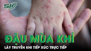 CDC Mỹ: Đậu Mùa Khỉ Lây Truyền Khi Tiếp Xúc Trực Tiếp Gần Và Lâu Dài | SKĐS
