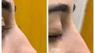 Non Surgical Rhinoplasty/ Non surgical nose job by dr Saleem