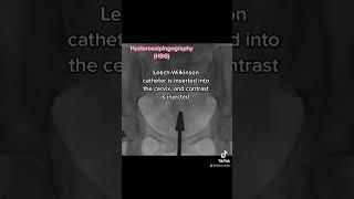 Hysterosalpingography (HSG) #fluoroscopy #radiology #radiologist #womenshealth