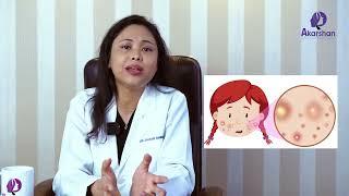 Acne Scar treatment by Dr.Smriti how to remove acne scar, deep scar removal #acnescars #akarshan