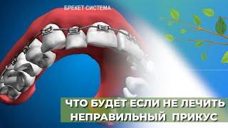 Что будет если не лечить неправильный прикус?