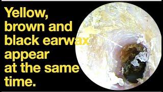 Yellow, brown and black earwax appear at the same time.|ear wax removal | ear cleaning | ASMR