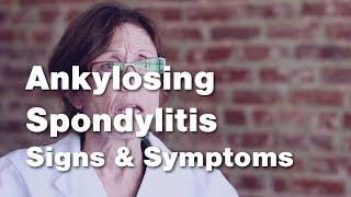 Ankylosing Spondylitis : Signs and Symptoms (2 of 5)