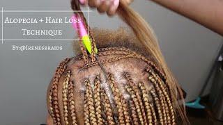 NEW TECHNIQUE| ALOPECIA + HAIR LOSS| BOX BRAIDS | @IRENESBRAIDS