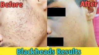 Blackheads Results Before and After | Sahil Nagpal Skin