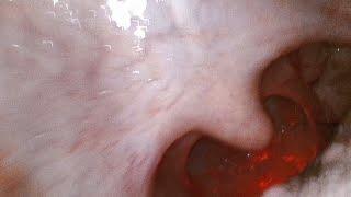 Looking Into a Mouth and Throat with a Tiny Camera