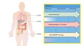 Antiangiogenic Treatments for Metastatic Colorectal Cancer