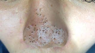 Big Cystic Acne Blackheads Extraction Blackheads & Milia, Whiteheads Removal Pimple Popping # 2533