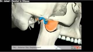 Prosthodontics - TMJ   Anterior Disc Displacement - Ottawa Dentist