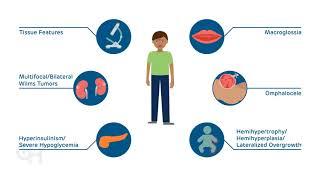 Introduction to Beckwith-Wiedemann Syndrome (BWS)