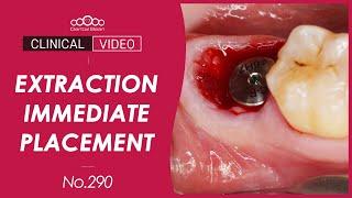 #47 Immediate Implant Placement [Dr. Cho Yongseok]