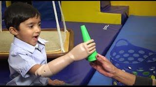 Prosthetic Myoelectric Arm Changes Child's Life