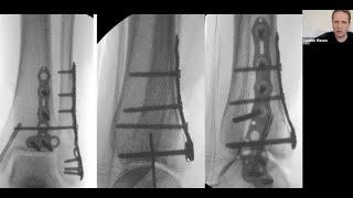 Posterior Malleolar Fractures - Where are we in 2022?   WIROC (Bombay Orthopaedic Society) L Mason