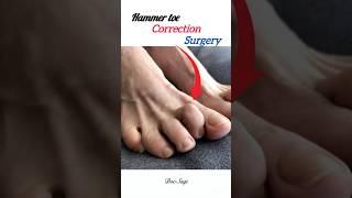 Hammer toe correction surgery| #hammertoes #ortho #surgerysuccess #shorts #medical #health #trending