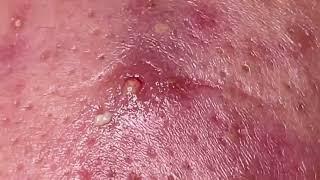 CYSTIC ACNE, Blackheads, Whiteheads & Milia Treatment