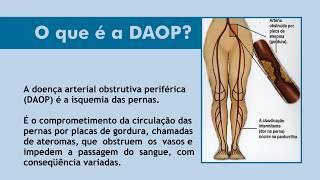 Doença Arterial Obstrutiva Periférica - DAOP