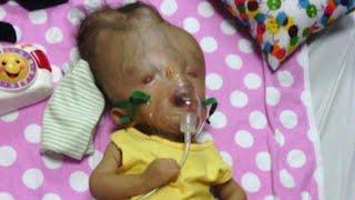 Toddler with Birth Defects 'Incompatible with Life' Defies Odds in Venezuela