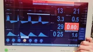 Applied: Asthma graphs How to get rid of auto peep. To peep or not to peep. Vent. Mode of choice