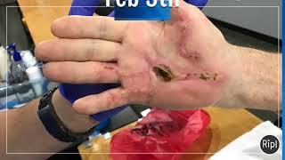 Advanced wound healing techniques at Ascend Hand Therapy