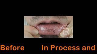 Inner Lip Tattoo Removal at Renwal Laser Clinic