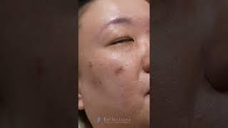 Hyperpigmentation from Acne Scars on Asian Skin