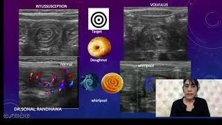 INTUSSUSCEPTION OR VOLVULUS ?