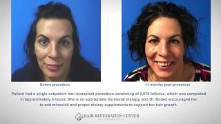 Transgender Hair Transplant - Dr. Scott Boden - Connecticut