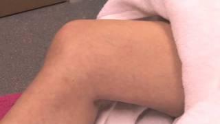 LIVE Laser thread veins removal by Cheshire Cosmetic