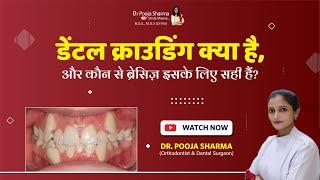 What Is Dental Crowding & Which Braces Are Effective For It? Teeth Perfect Alignment In Agra, UP