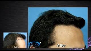 Adam done hair transplant surgery from Dr. A's Clinic non balding hairline/vitruvian formula.