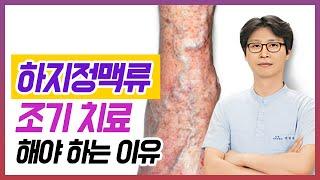 [헬스인뉴스 - 건강멘토] 하지정맥류, 조기에 치료해야 하는 이유