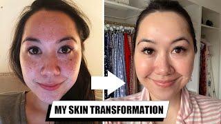 HOW I TRANSFORMED MY SKIN | Pigmentation Correction + My Skincare Routine