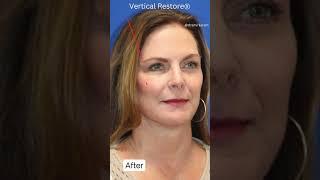 Look 20 Years Younger? GORGEOUS Facelift Transformation!